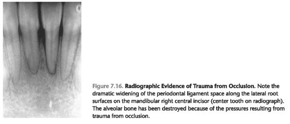 Direct Damage from Occlusal Forces